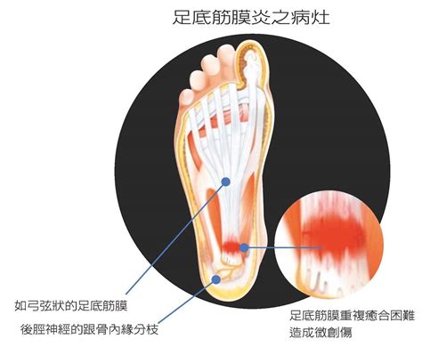 吱腳板底|腳踭痛？腳板底痛？足底筋膜炎的位置、症狀及治療